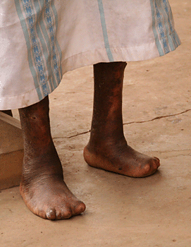 leprosy